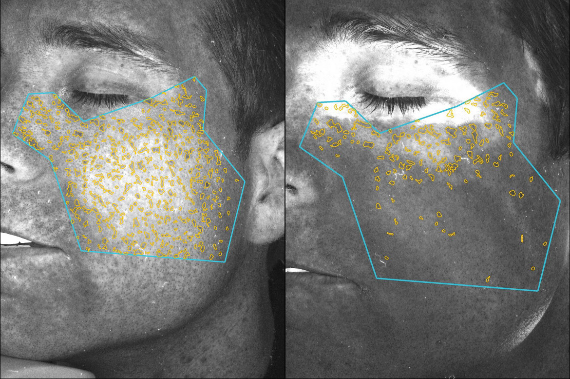 Complexion Analysis