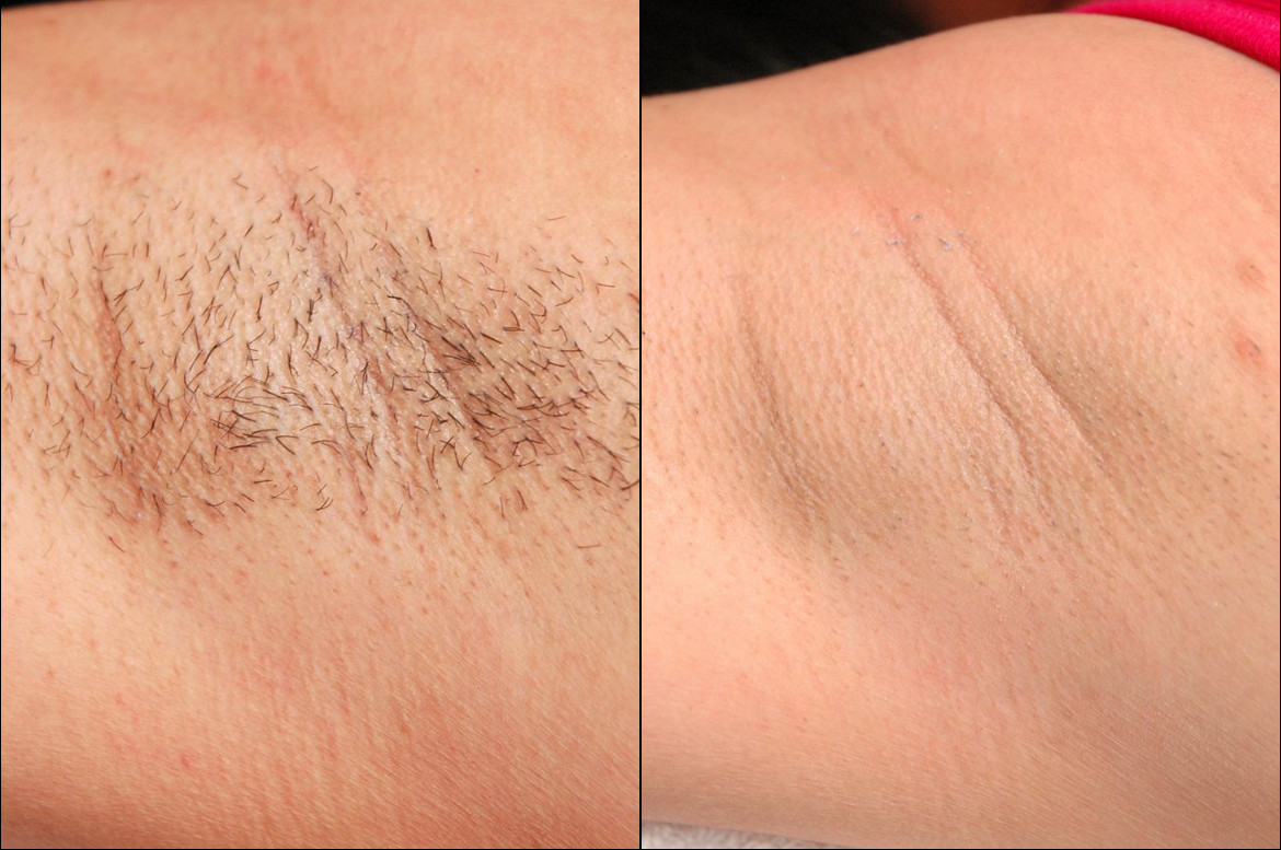 Laser Hair Removal