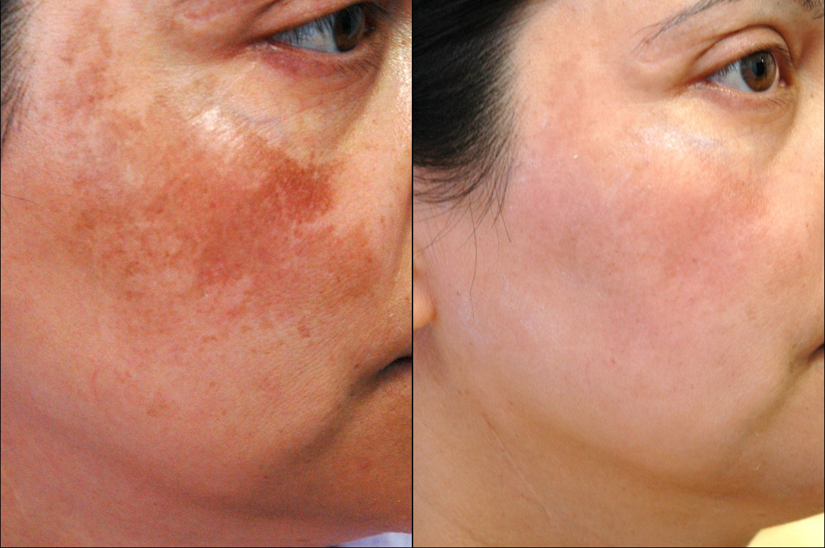 Pigmentation Treatments