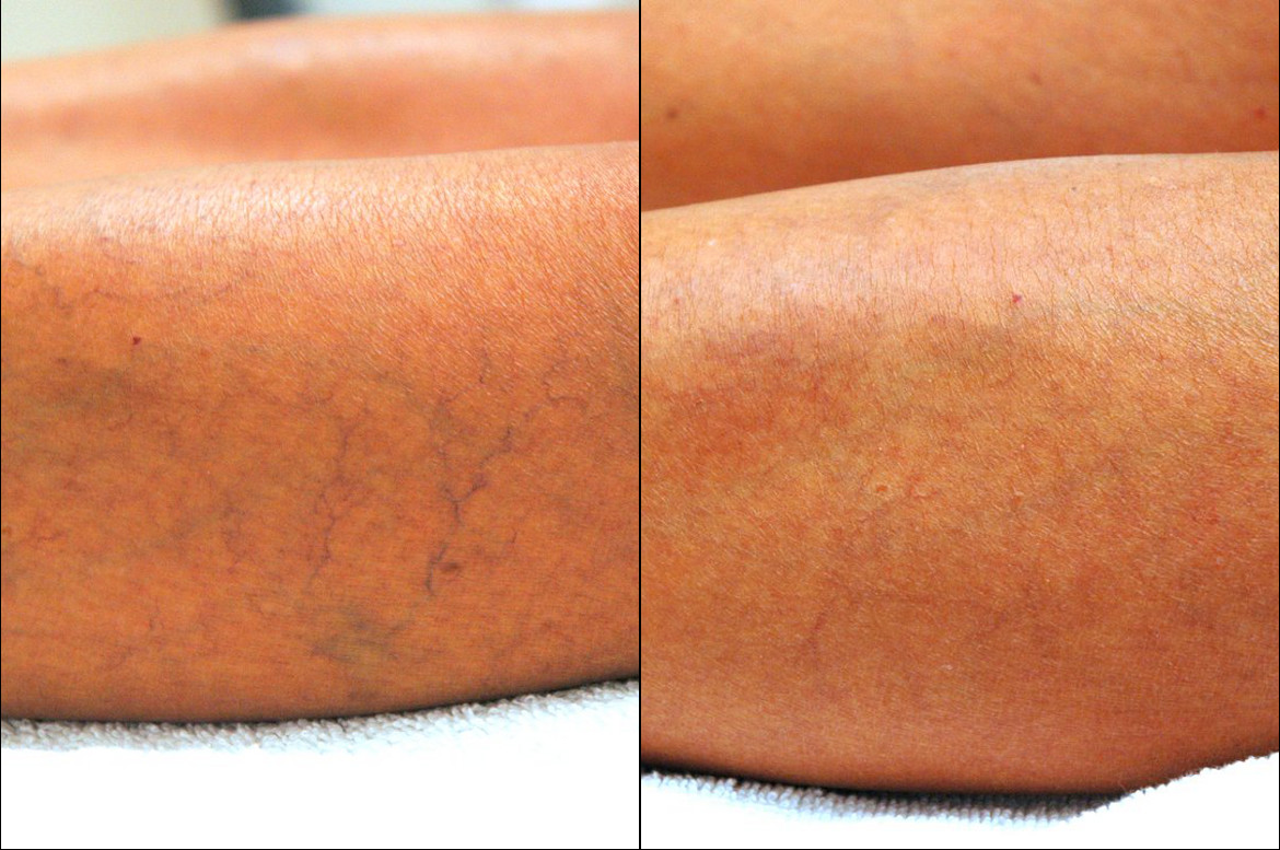 Spider Veins Treatments